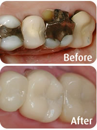 One Day Crowns - Before & After